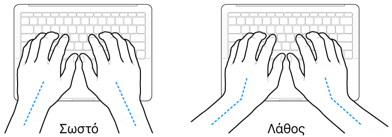 Χέρια τοποθετημένα επάνω σε ένα πληκτρολόγιο, που δείχνουν τη σωστή και τη λανθασμένη θέση των καρπών σε σχέση με τα χέρια.