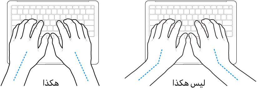 يدان موضوعتان على لوحة مفاتيح، وتظهر المحاذاة الصحيحة وغير الصحيحة للمعصم واليد.