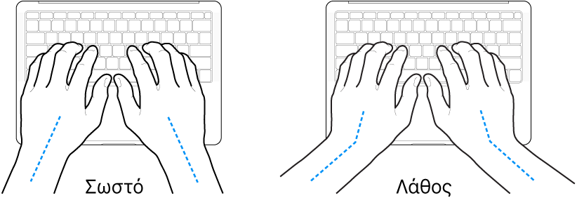 Χέρια τοποθετημένα επάνω σε ένα πληκτρολόγιο, που δείχνουν τη σωστή και τη λανθασμένη θέση των καρπών σε σχέση με τα χέρια.