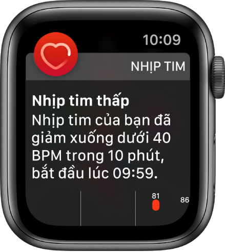 Một màn hình Cảnh báo nhịp tim cho biết rằng một nhịp tim thấp đã được phát hiện.