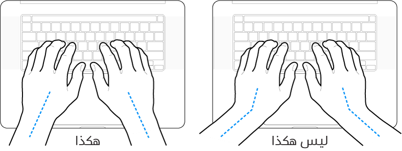 يدان موضوعتان على لوحة مفاتيح، وتظهر المحاذاة الصحيحة وغير الصحيحة للمعصم واليد.