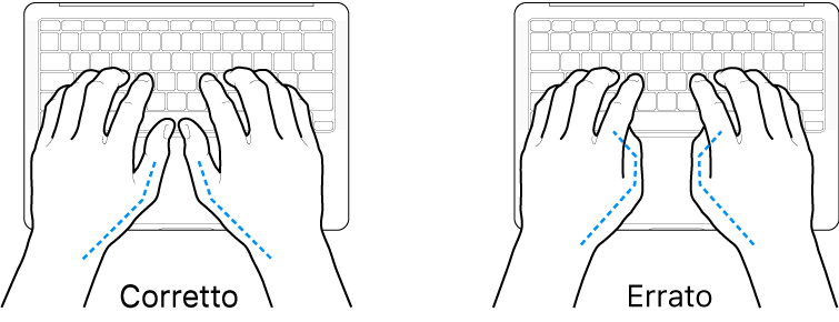 Mani posizionate su una tastiera che illustrano il posizionamento corretto ed errato dei pollici.