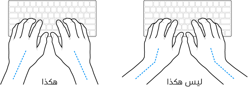 يدان موضوعتان على لوحة مفاتيح، وتظهر المحاذاة الصحيحة وغير الصحيحة للمعصم واليد.