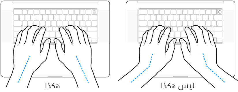 يدان موضوعتان على لوحة مفاتيح، وتظهر المحاذاة الصحيحة وغير الصحيحة للمعصم واليد.