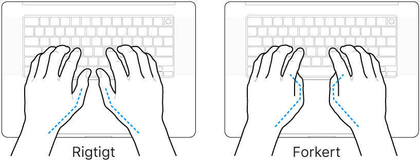 Hænder anbragt over et tastatur med rigtig og forkert position af tommelfingre.