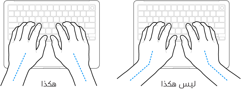 يدان موضوعتان على لوحة مفاتيح، وتظهر المحاذاة الصحيحة وغير الصحيحة للمعصم واليد.