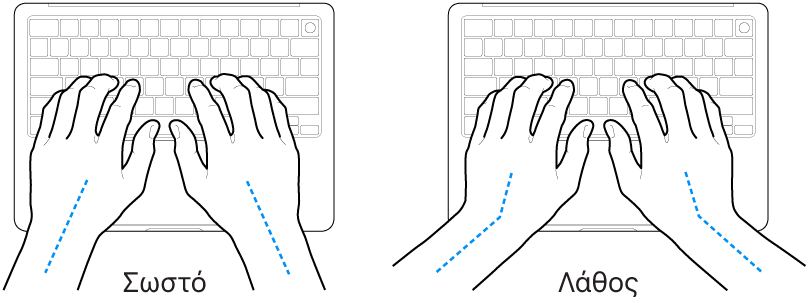 Χέρια τοποθετημένα επάνω σε ένα πληκτρολόγιο, που δείχνουν τη σωστή και τη λανθασμένη θέση των καρπών σε σχέση με τα χέρια.